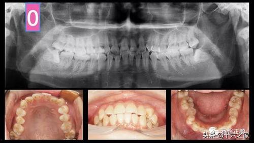 隐形牙套皮筋挂法视频,轻松掌握矫正技巧