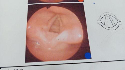 声带息肉手术视频,专业视角下的微创治疗体验